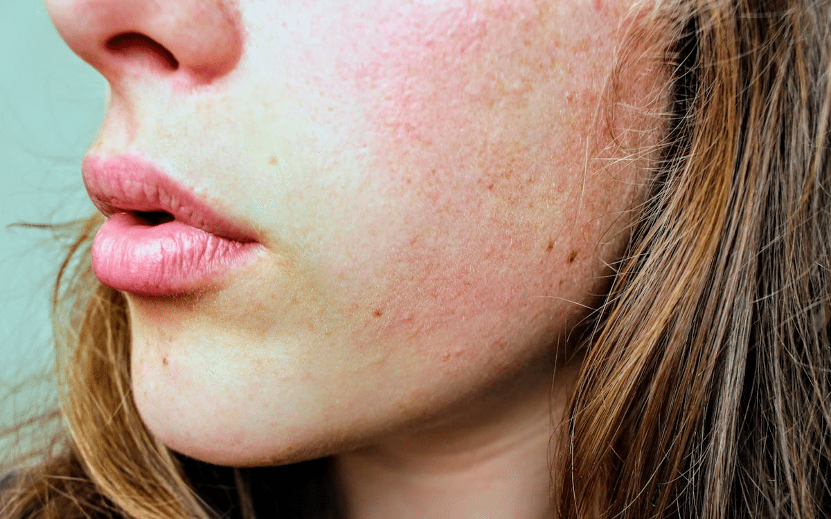 The Best Natural Remedies for Common Skin Concerns - Finally All Natural