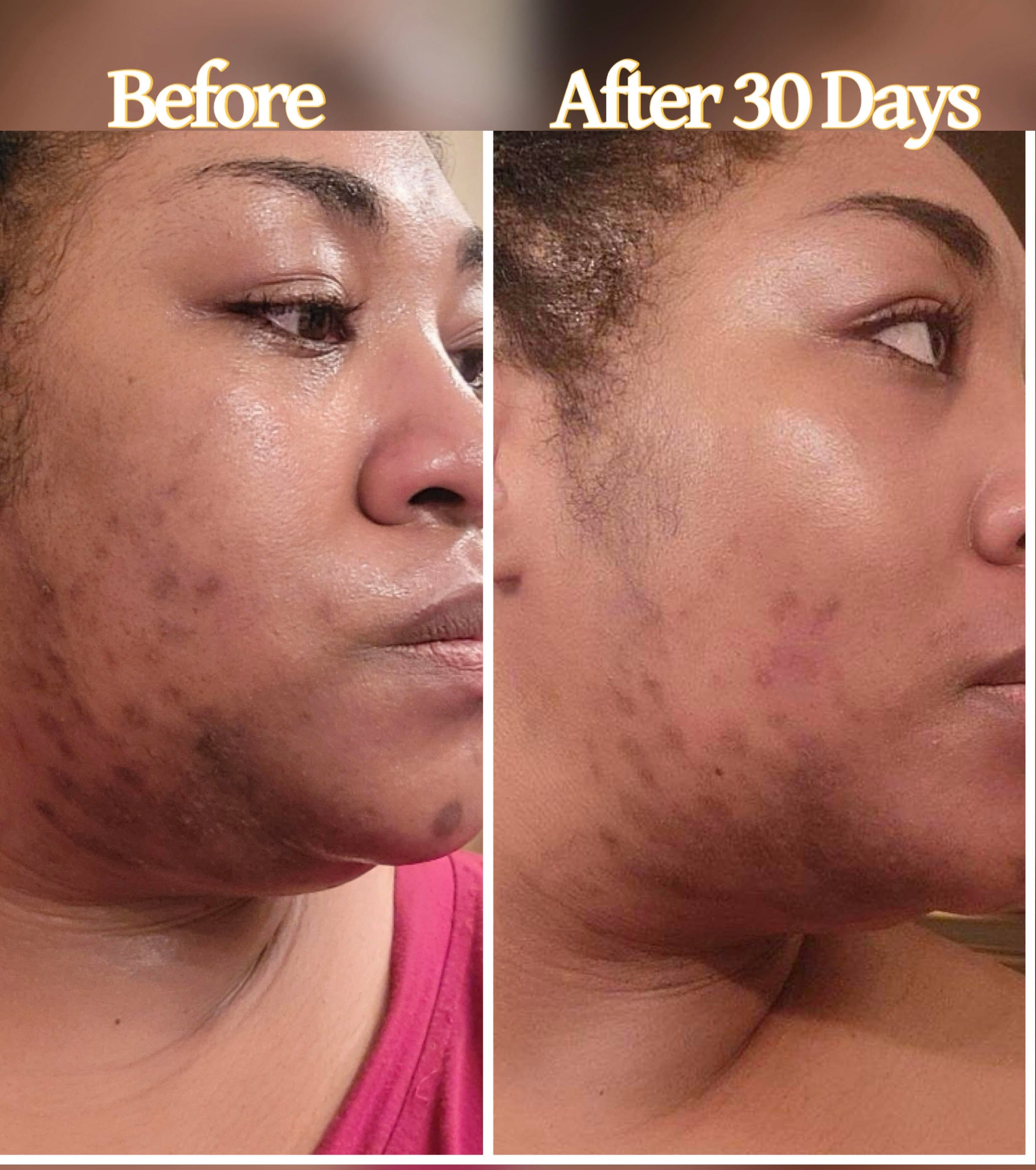 Acne_scars_and_dark_spots_2.jpg