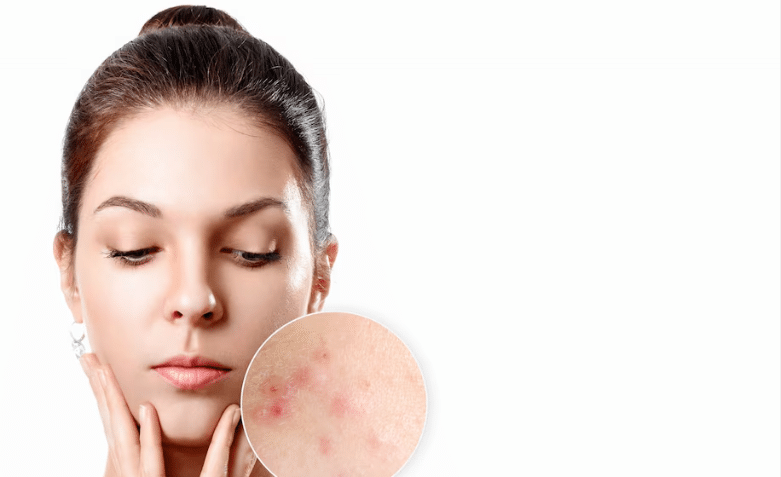 Breaking the Cycle: How to Transition Off Harsh Acne Treatments Naturally - Finally All Natural