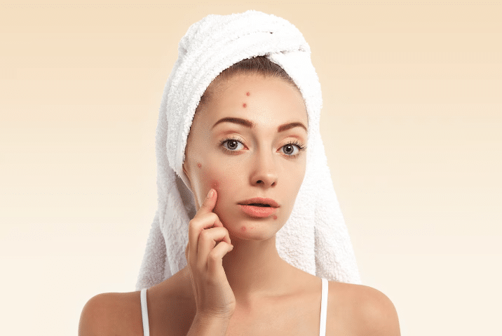 Conquer Breakouts: The Best Natural Acne Treatments for Sensitive Skin - Finally All Natural