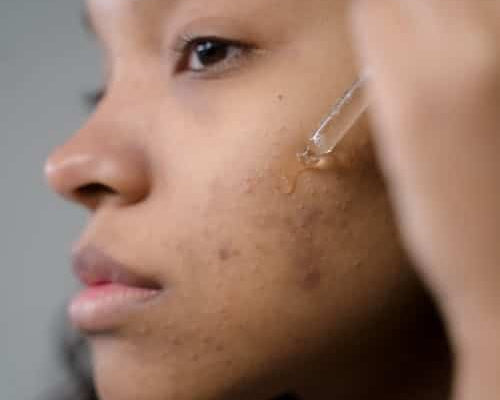 Healing Acne Naturally Using Facial Oils for Acne Prone Skin - Finally All Natural