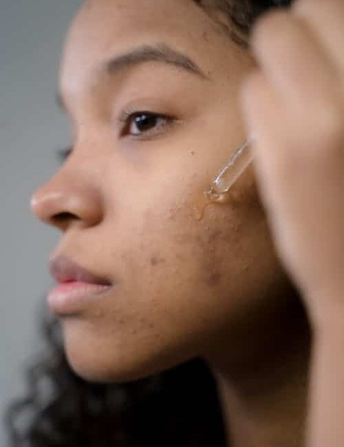 Healing Acne Naturally Using Facial Oils for Acne Prone Skin - Finally All Natural