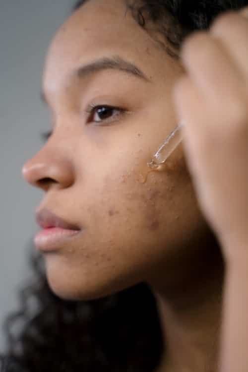 Healing Acne Naturally Using Facial Oils for Acne Prone Skin - Finally All Natural
