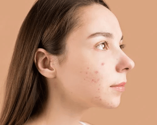 The Hidden Acne Trigger: Excess Salt - Finally All Natural