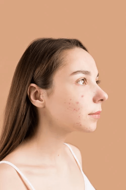 The Hidden Acne Trigger: Excess Salt - Finally All Natural