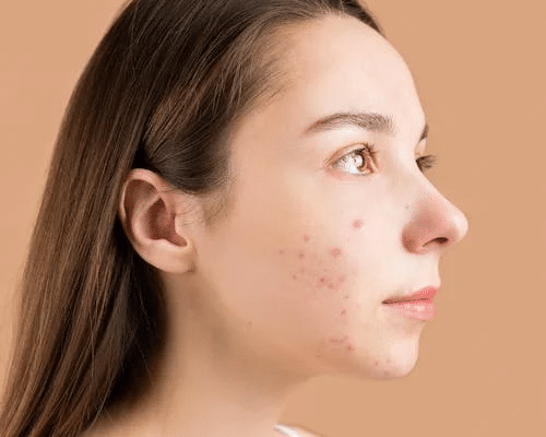 The Hidden Acne Trigger: Excess Salt - Finally All Natural