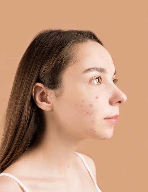 The Hidden Acne Trigger: Excess Salt - Finally All Natural