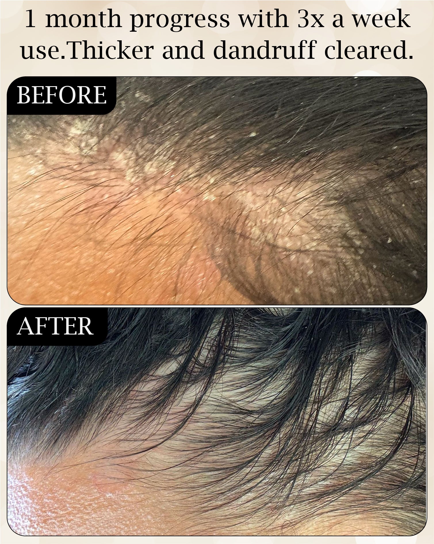 Hair Growth + Dandruff Relief Scalp Oil Set