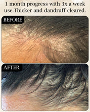 Hair Growth + Dandruff Relief Scalp Oil Set