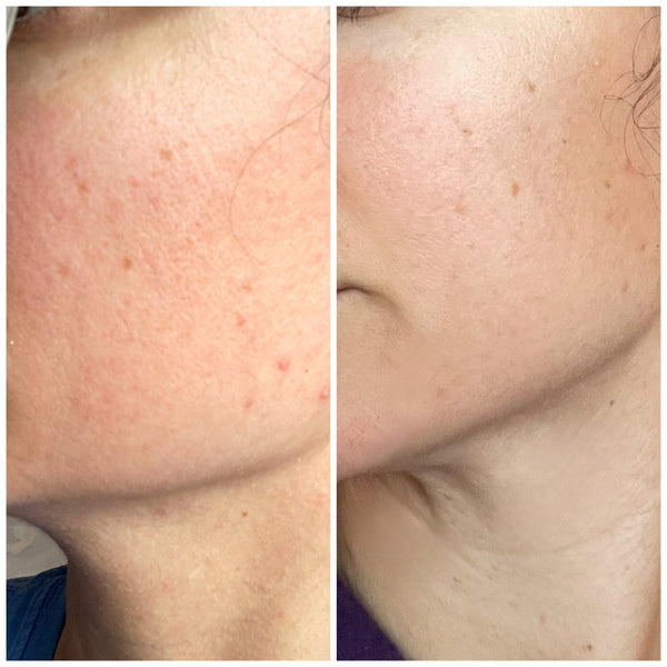 My skin was so irritated and highly sensitive. This oil has saved my skin!