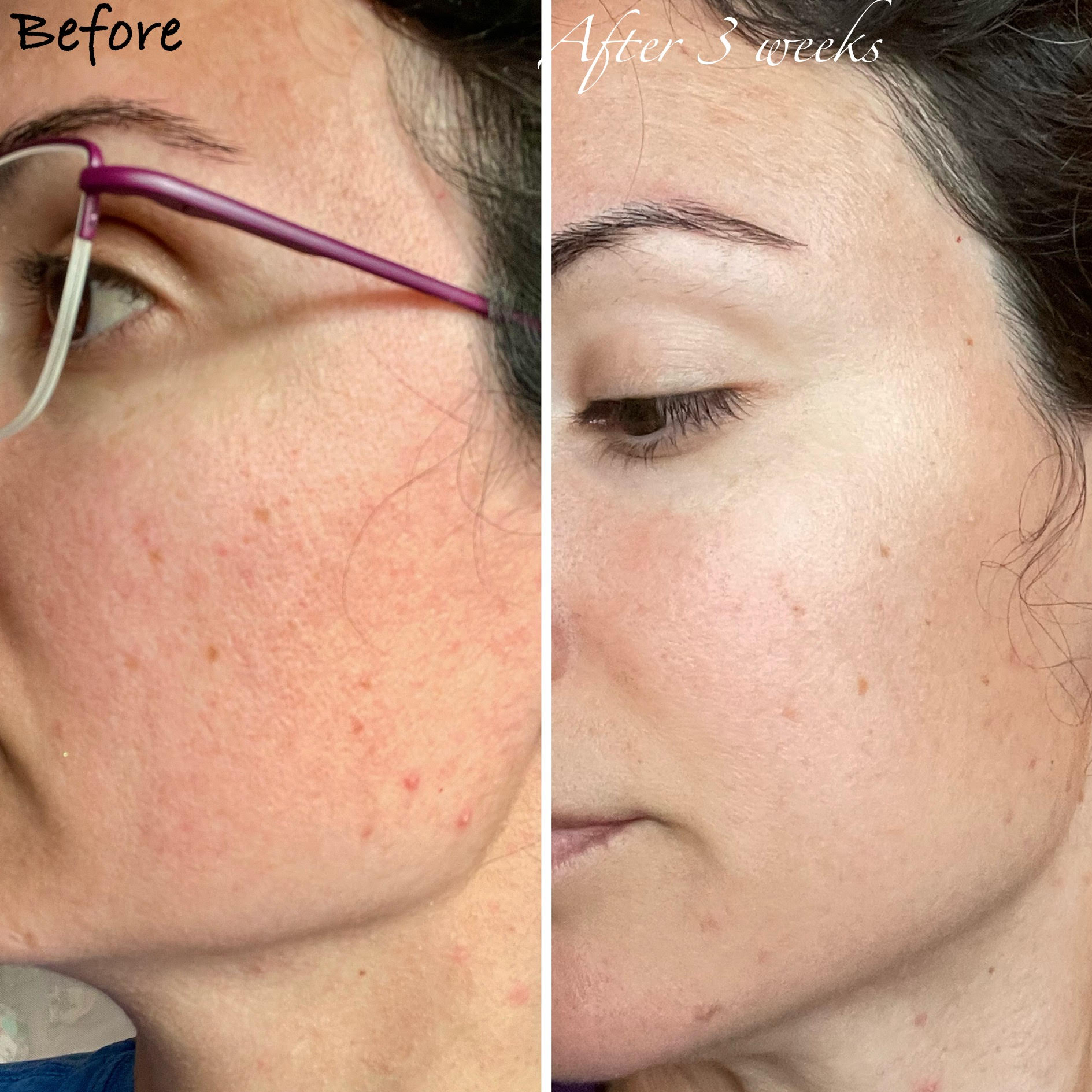 Heals Irritated Skin and Reduces Redness