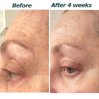 Plumps Fine Lines and Prevents Premature Aging
