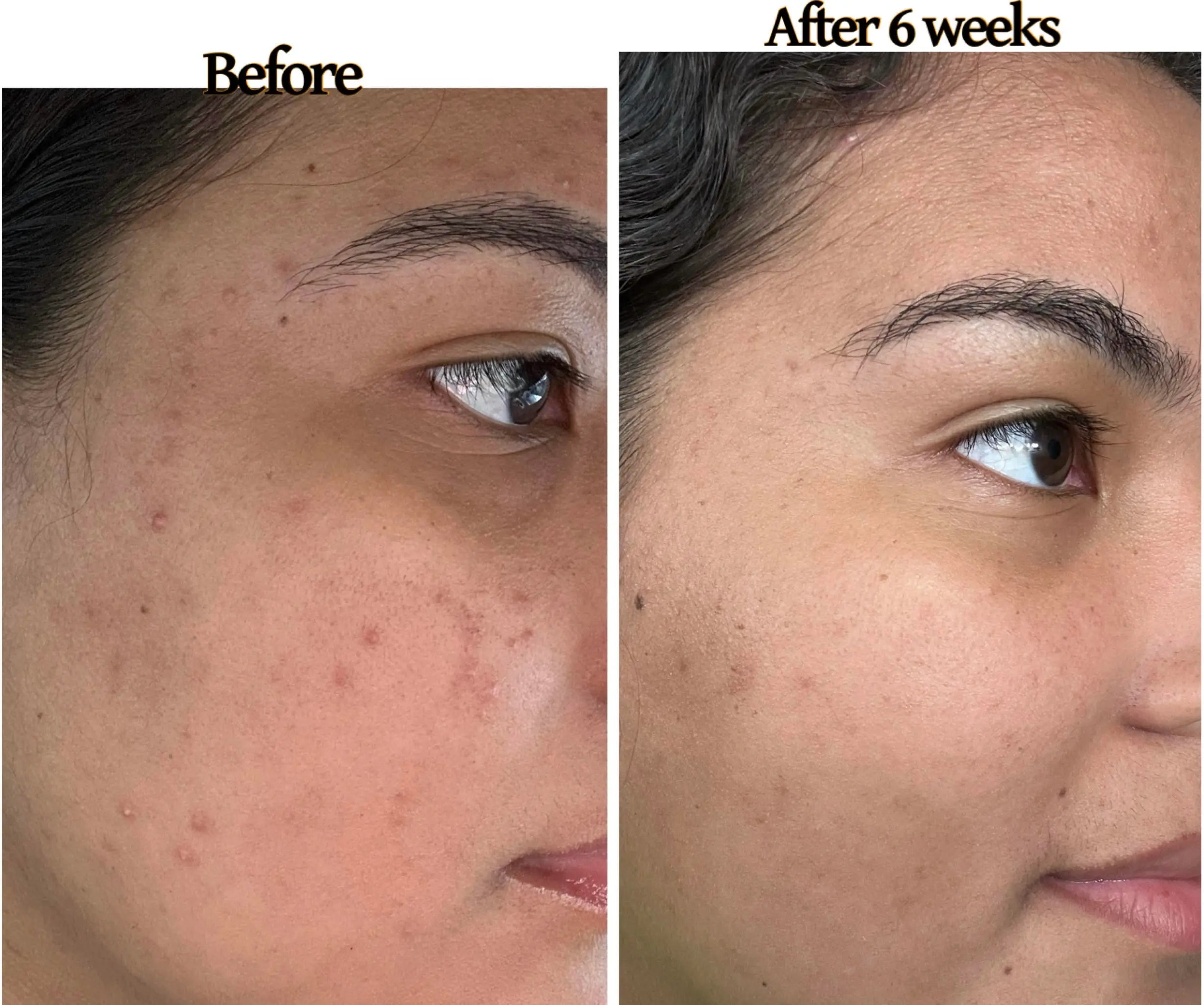 acne treatment